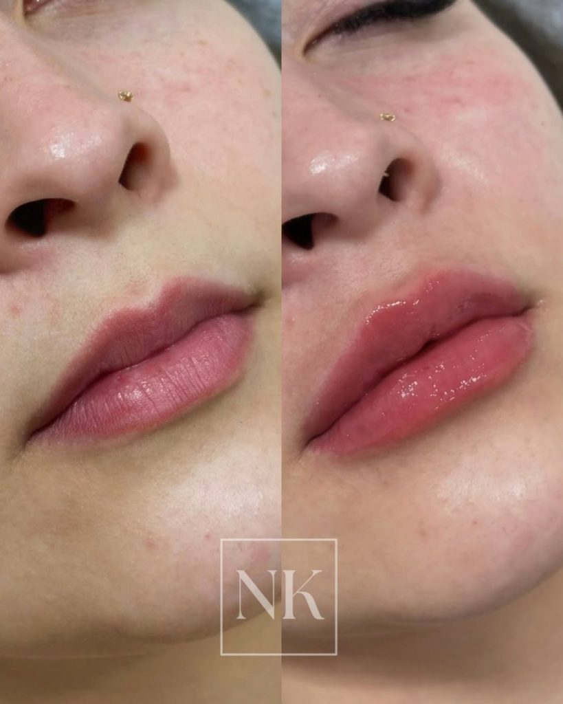 preenchimento-labial