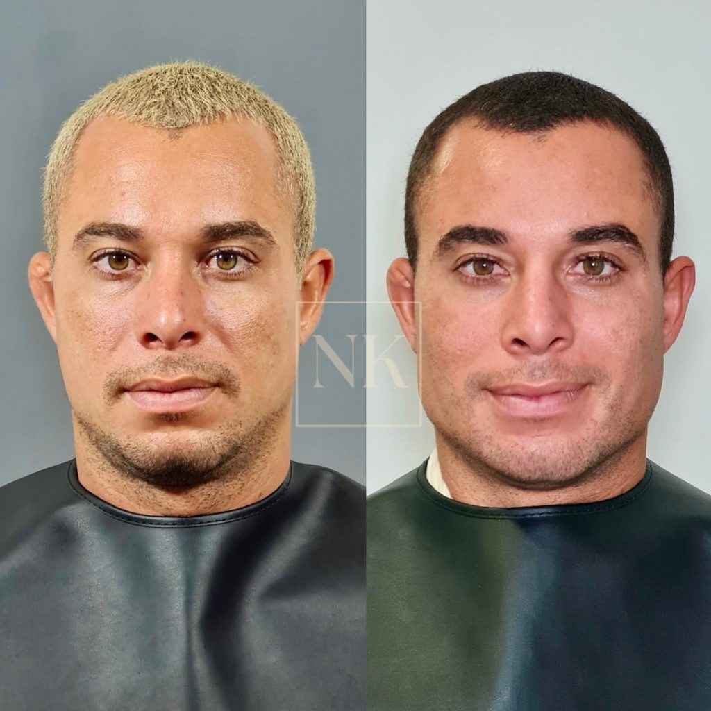 harmonizacao-orofacial